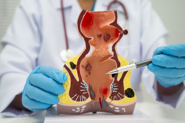 Fistula Surgery